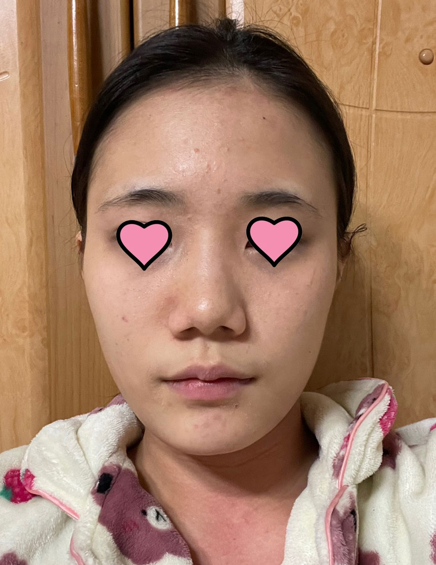 진짜 제 단점을 다 보완해주시고 완벽한 코를 만들어주시다니 진짜 감사합니다 !