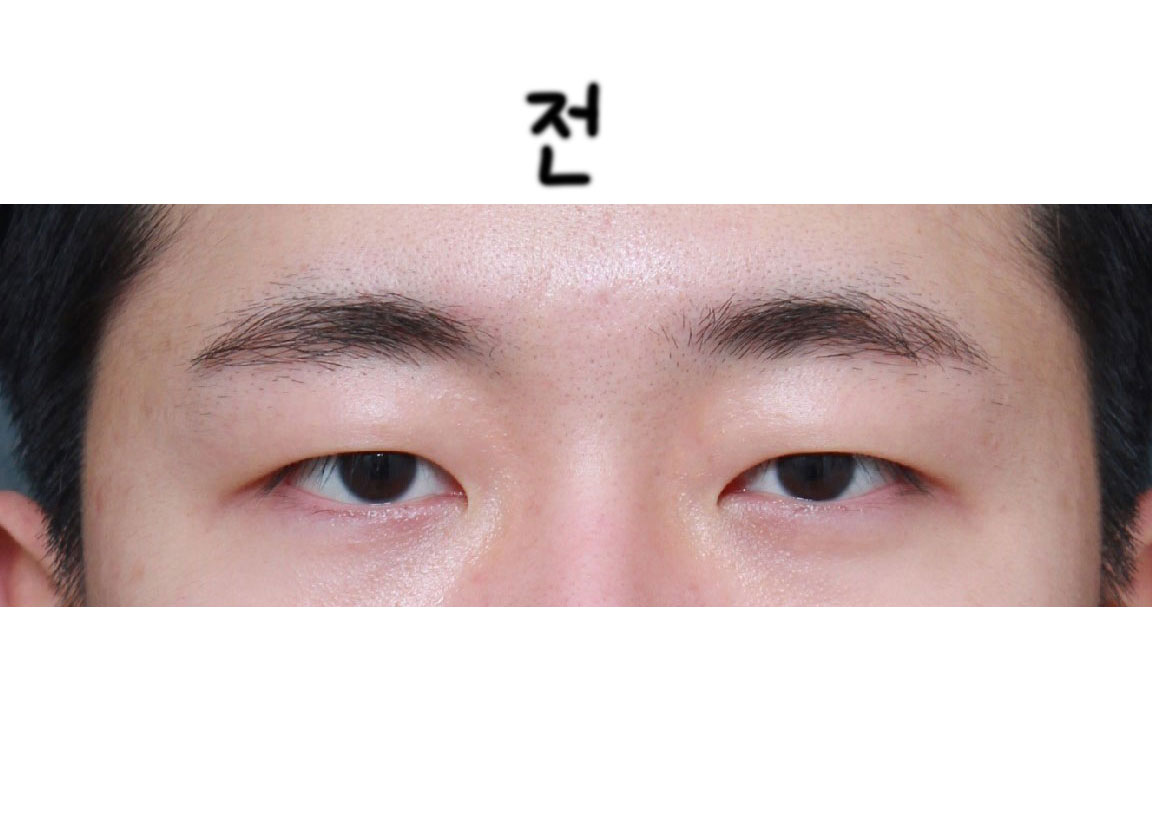 박상욱원장님께 수술한지 5달정도가 넘었네요.