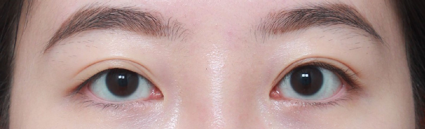 붓기도 정말 빨리 빠졌고 라인도 너무 마음에 들어요~~