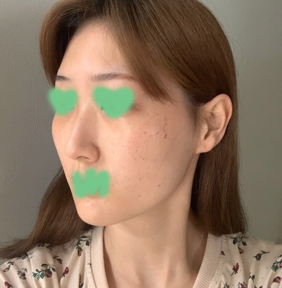 몇년동안 달고살던 컴플렉스가 며칠만에 없어져서 너무 좋았습니다 정말 적극 추천해요!!