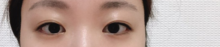 수술 후에도 원장님께서 경과 봐주셨는데 이렇게 환자 소중히 봐주시는 분 드문 것 같아요!! 후기남겨드립니다