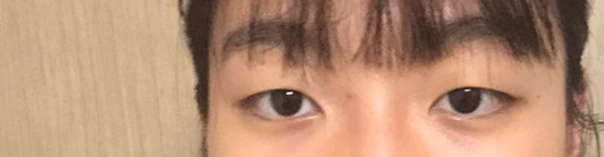 수술해주신 박상욱 원장님과 상담해주신 실장님 두 분 모두 매우 친절하게 잘해주셔서 첫 수술인데 떨지 않고 했네요 감사합니다 !~~