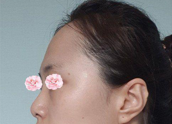 실장님도 원장님도 너무 친절하시고 콧대도 코끝도 맘에 듭니다 !!