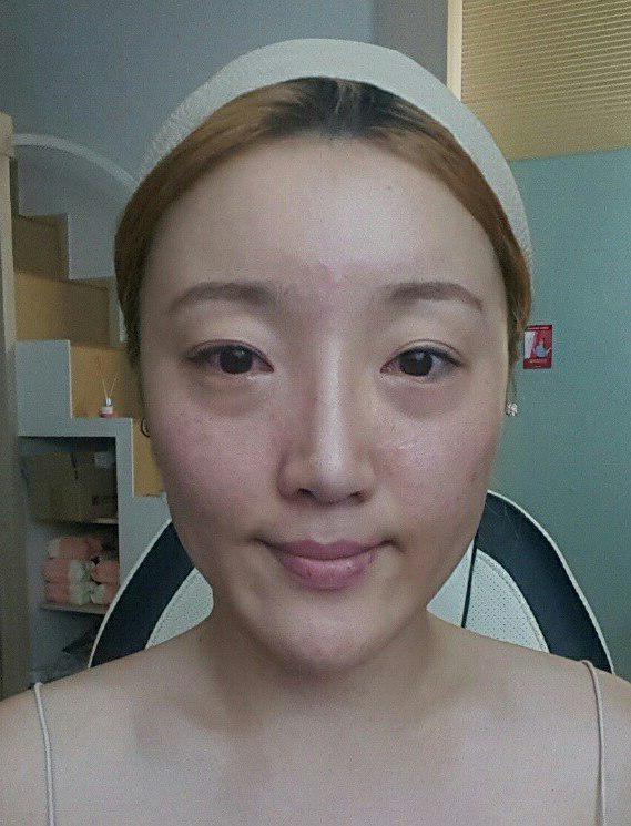 쌍커풀(절개)+뒷 밑트임+윤곽3종+눈밑지방재배치 3주차 후기 입니다.
