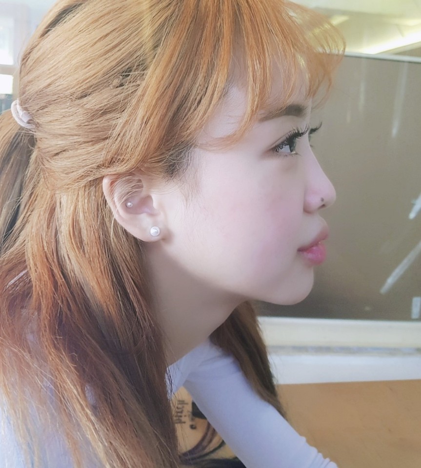 쌍커풀, 자연유착, 눈매교정, 눈트임 앞,뒷,밑 아주 그냥 싹다틈!