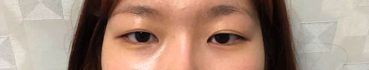 눈 재수술이라 더 신중했는데 손원장님이 상담도 꼼꼼하게 잘 해주셨어요!!