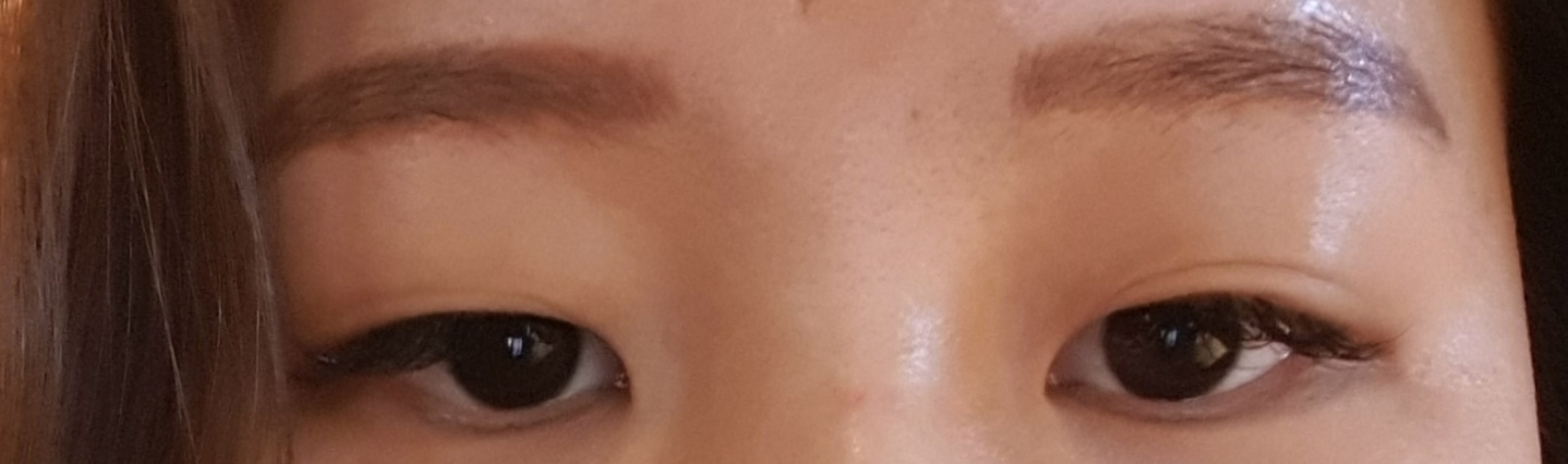 5월11일에 자연유착매몰 + 앞트임 진행 했어요~