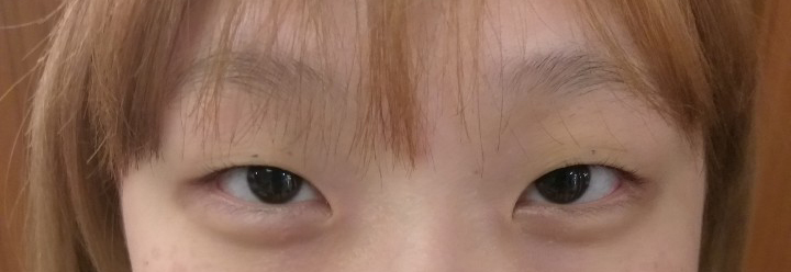 수술한 지 3달정도 되었는데 붓기가 점점 빠지면서 자리 잡고 있는거 같아요!!