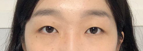 쌍수 후기 올려요!!ㅎㅎ