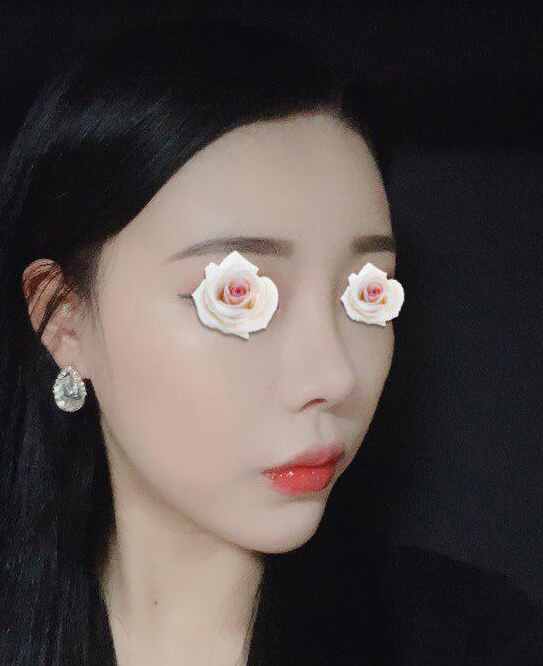 임영민원장님께 코성형받은지 한달차 입니다.