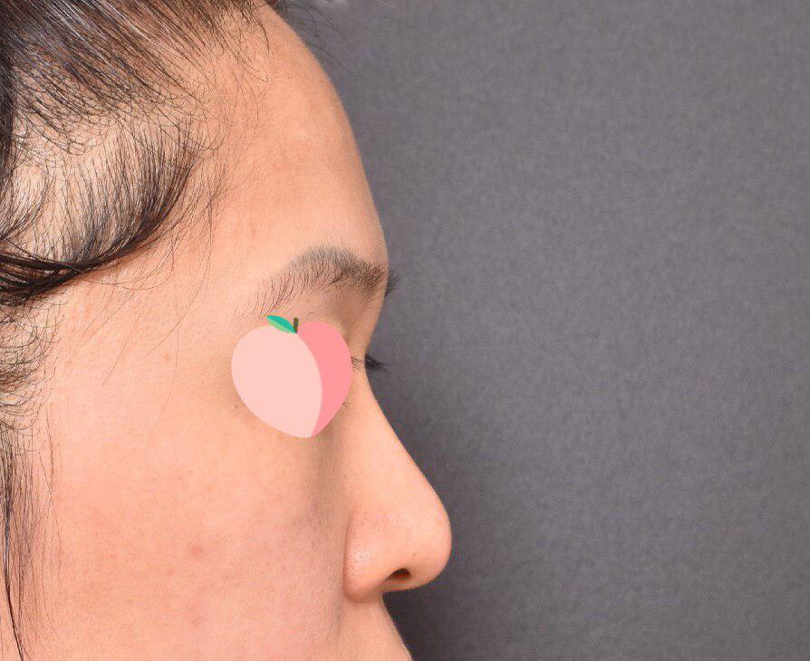 베리굿 성형외과 임영민 원장님께 코성형 받았어용