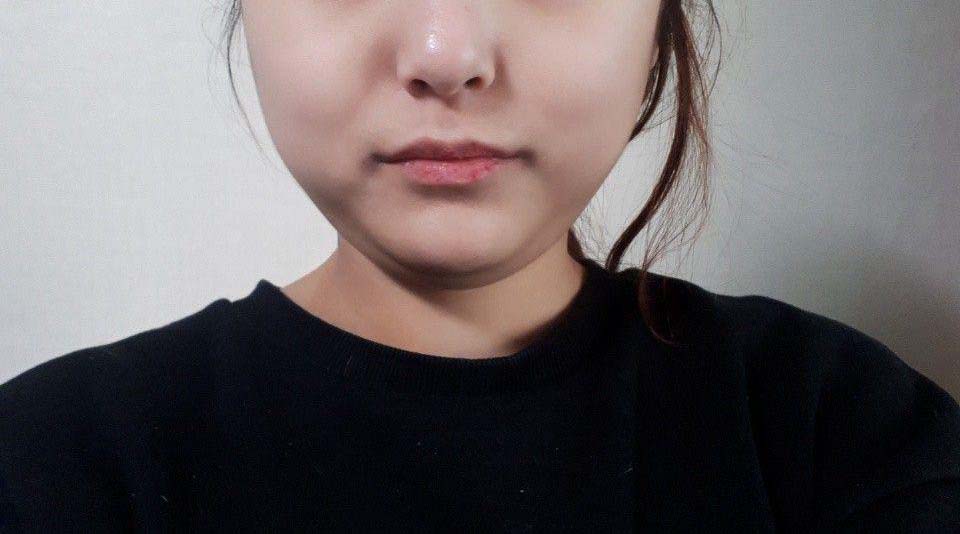 생애 첫 지방흡입해봤어요~!