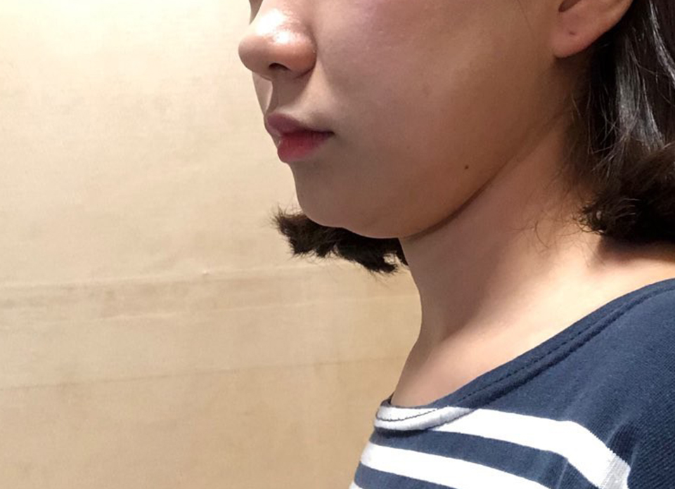 이중턱 지방흡입 신세계입니다..bb