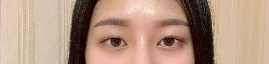 매몰로 눈매교정했는데 너무 만족스러워요!