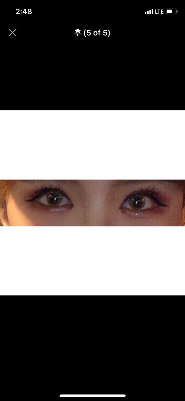 수술한지 3개원 지나가고 있어요:)