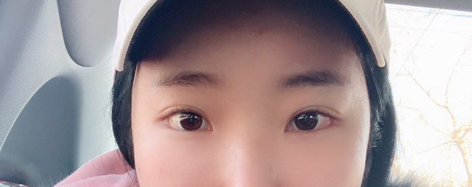 밑트임재수술 했어요ㅎㅎ