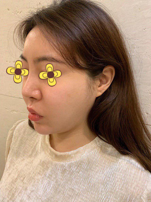 실리프팅하길잘했어요ㅠㅠ