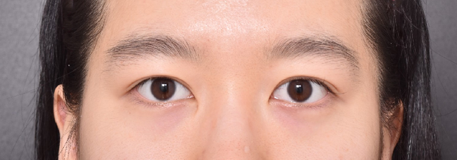 눈재수술 성공적이예여ㅠㅠ