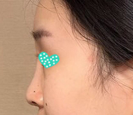 코수술한지 63일 지났네용~