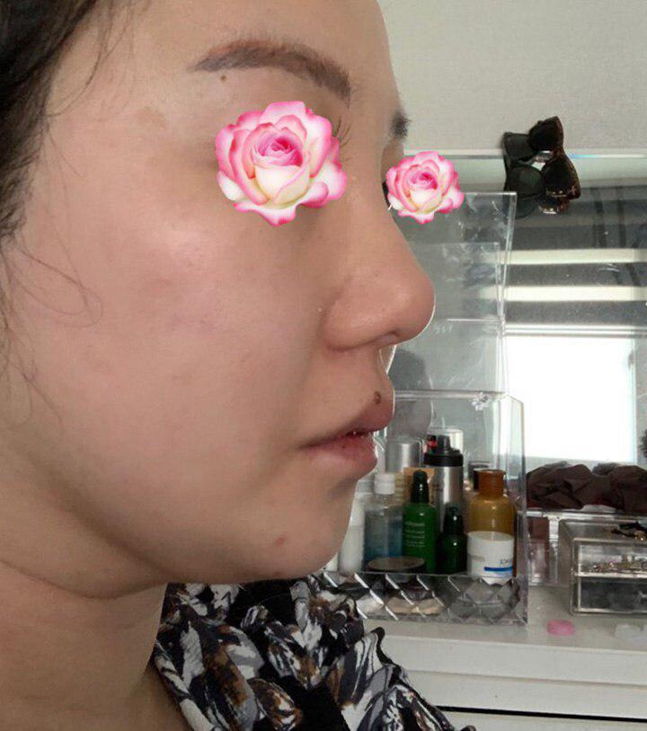 베리굿성형외과에서 코성형했습니다.