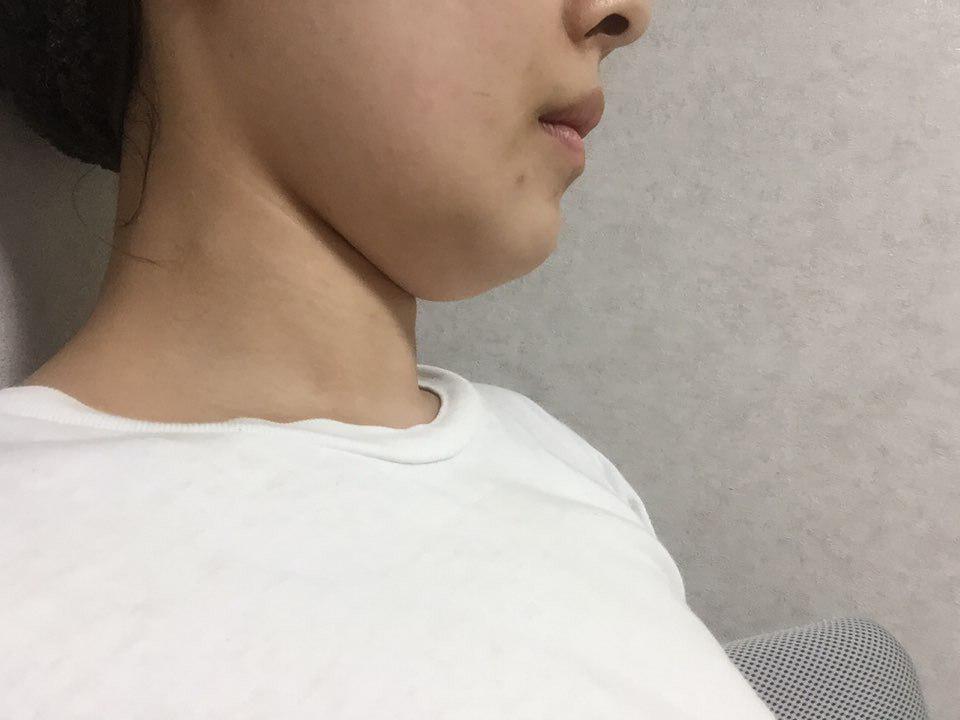 이중턱 지방흡입하고 왔어요~!!