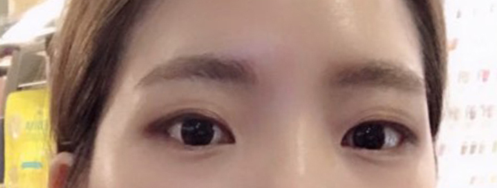 절개로 쌍수한지 5주~6주 정도 된 후기 입니다ㅋㅋㅋ