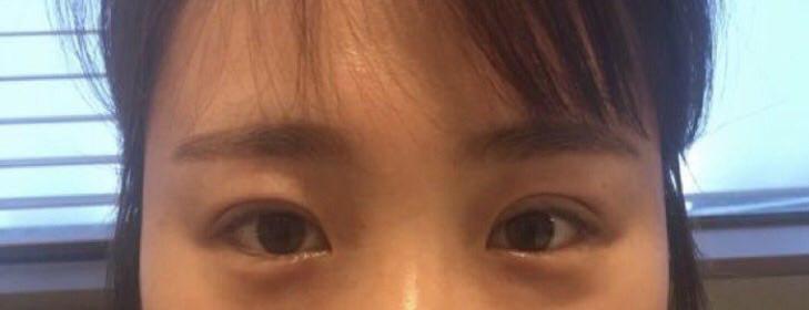 눈성형후 12일차후기예요~