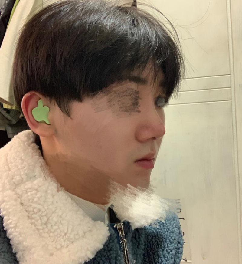 코 재수술 수술후기