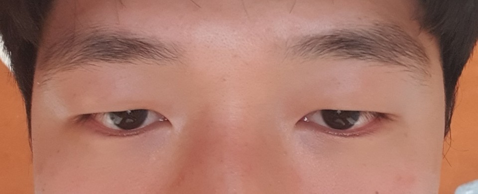 Phẫu thuật cắt mí mắt