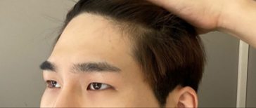 Đánh giá sau 5 tháng thực hiện phẫu thuật chỉnh sửa mí mắt và nâng trán!