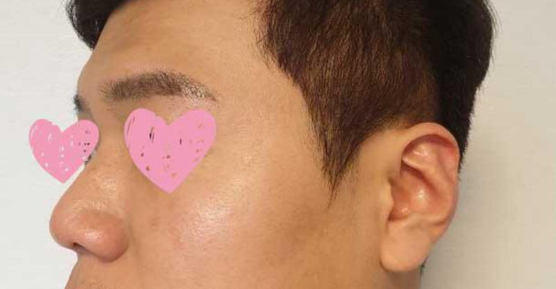 Sống mũi, đầu mũi, chỉnh sửa mũi to, mũi гор