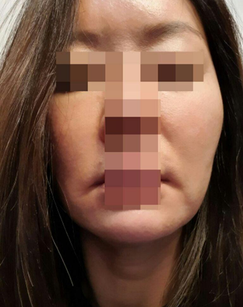 Cấy mỡ dưới mắt, căng da mặt