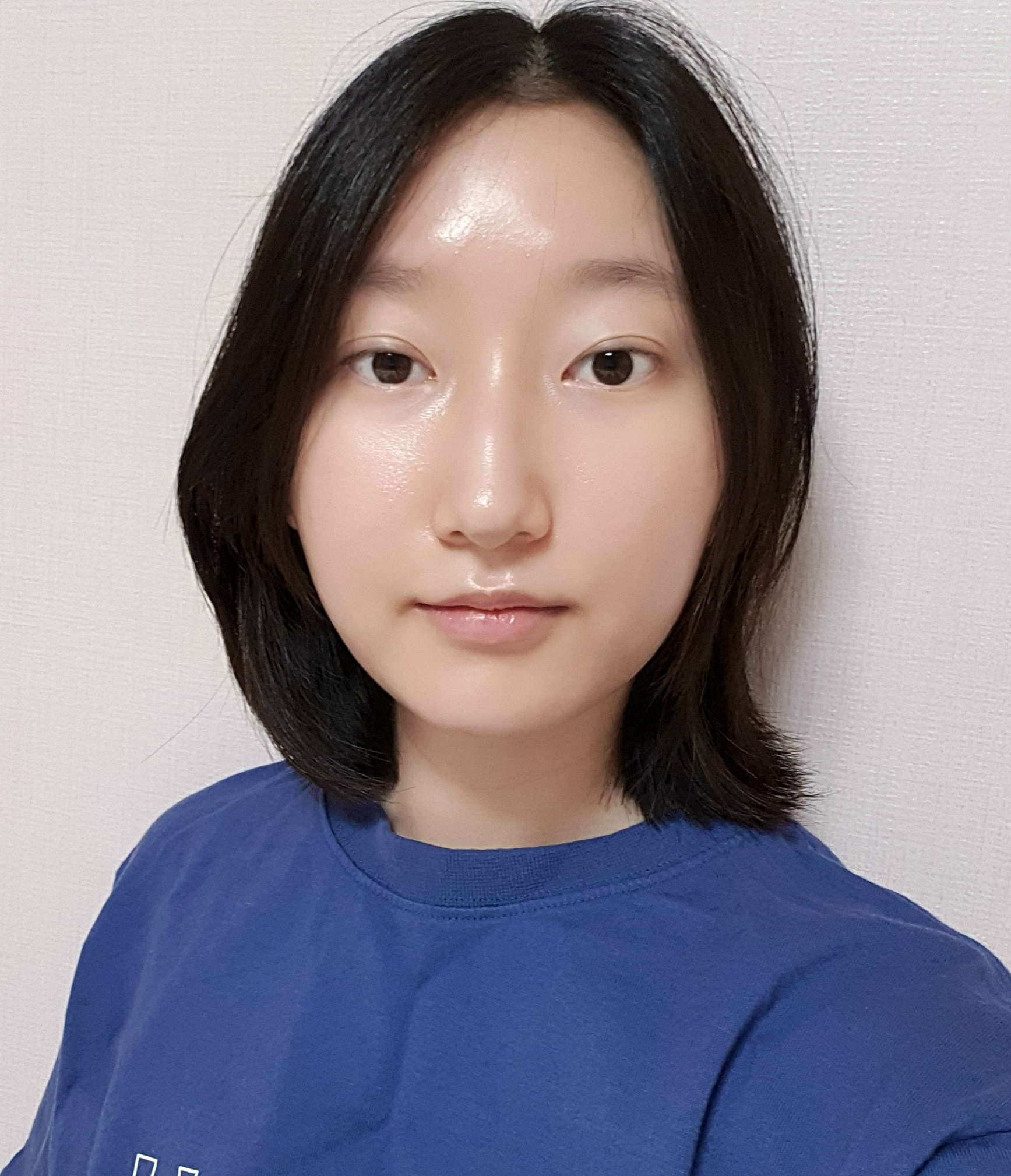 [Mắt] Trứng cuộn - Tái phẫu thuật chỉnh sửa mí mắt cắt mí, mở góc mắt dưới