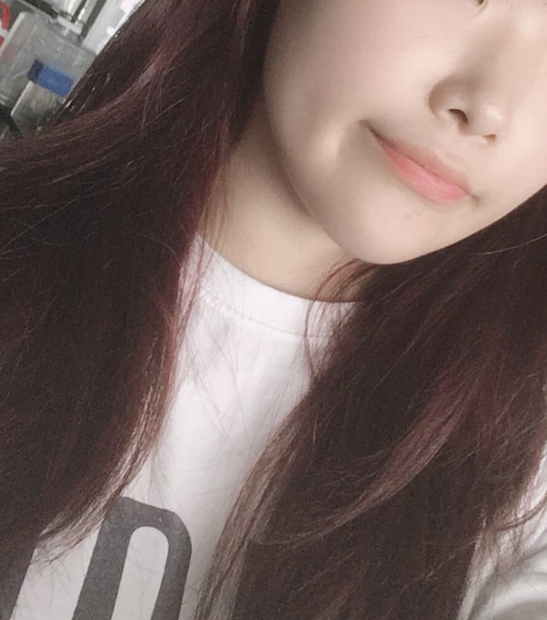 [Tiểu phẫu] Bongbingi - Filler