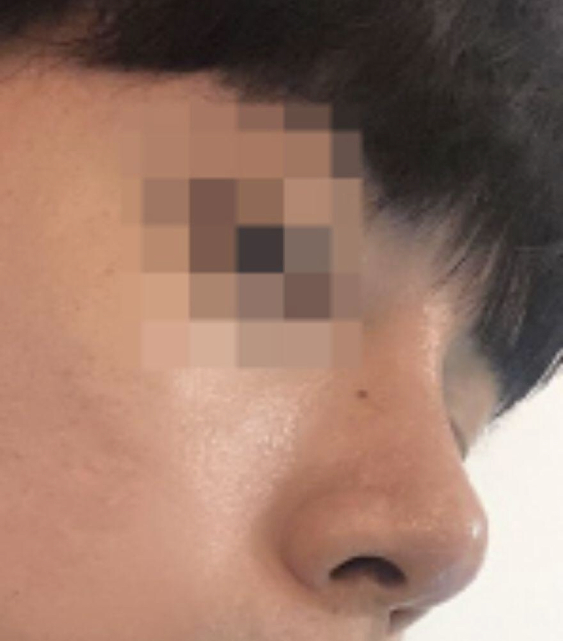 [Mũi] Koz802 - Sống mũi