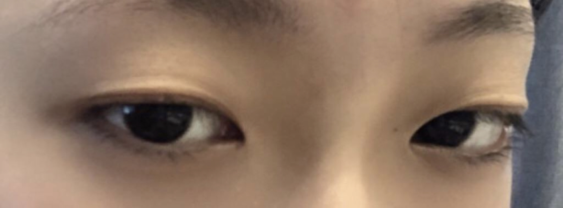 [Mắt] kkmmgg52 - Cắt mí (phương pháp chôn chỉ)