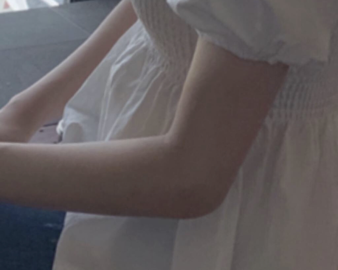 [Tiểu phẫu] Kyahakyukyu - Tiêm tan mỡ