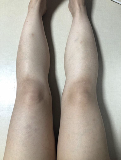 [Hút mỡ] zz0808 - Hút mỡ