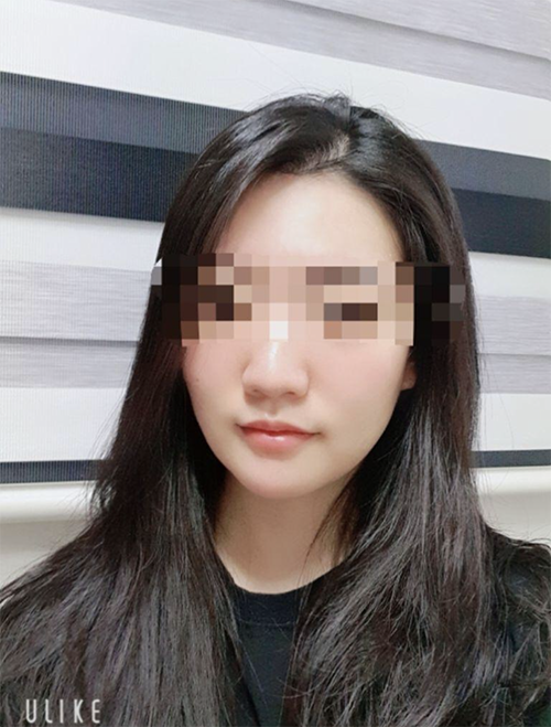 [Tiểu phẫu] [Hội viên ngR5DA2] - Ultherapy, Botox