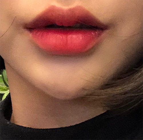 [Жижиг] ddd97 - Филлер, Ботокс