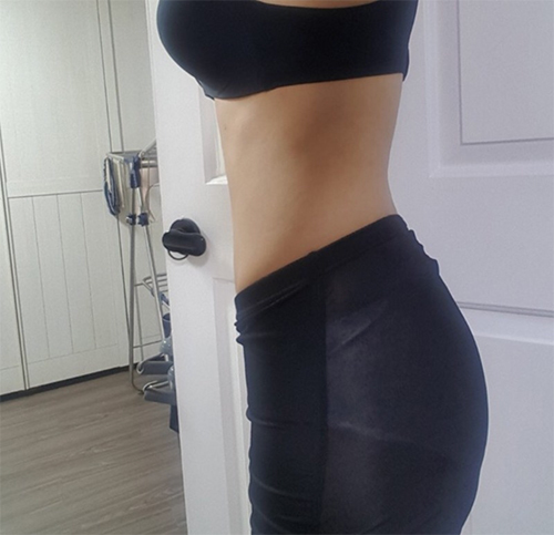 [Өөх соруулах] Juvederm - Өөх соруулах (хэвлий)