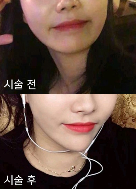 [Бяцхан] Яала Шонгс - Эрүүний филлер