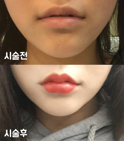 [Жижиг] bobommm - Уруулын филлер