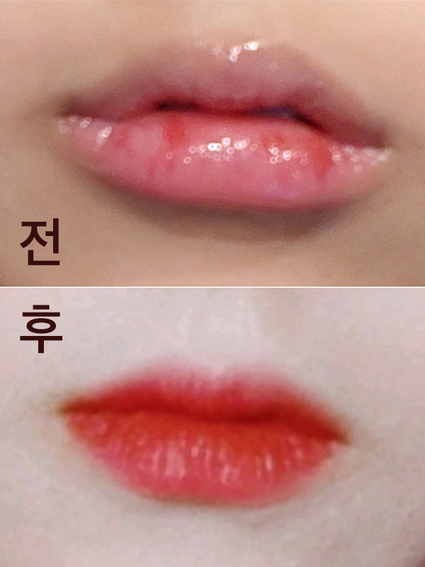 [Жижиг] Уруулын дүүргэлт - Филлер, ботокс