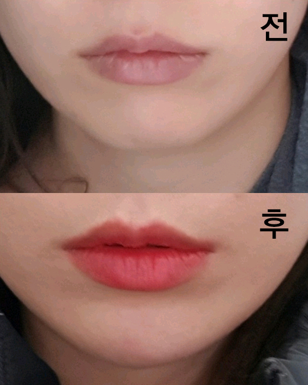 [Жижиг] Том - эрүүний үзүүрт филлер, ботокс