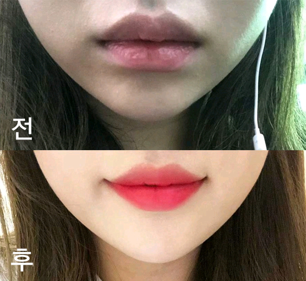 [Бяцхан] Конгкронг - Уруулын филлер