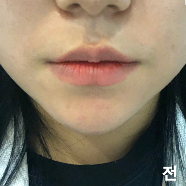 [Жижиг] Дотторуя - Уруулын филлер, ботокс