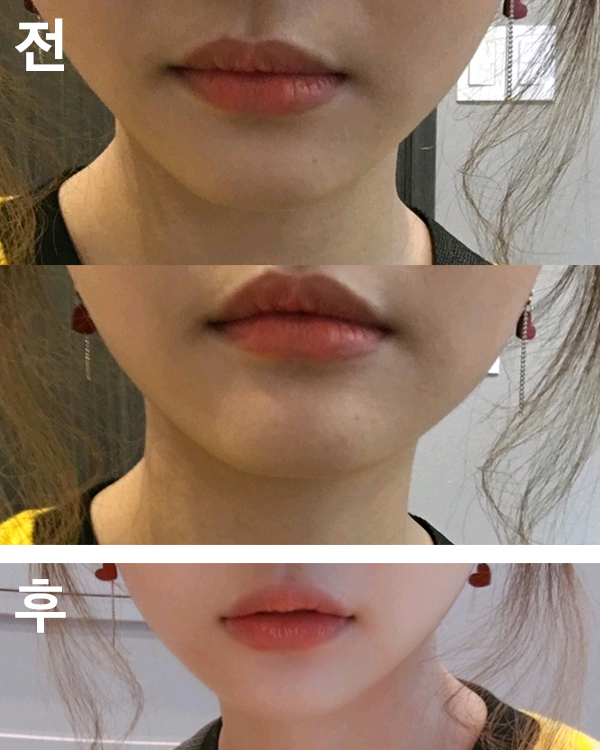 [Бяцхан] Дэгүлсс - Уруулын филлер