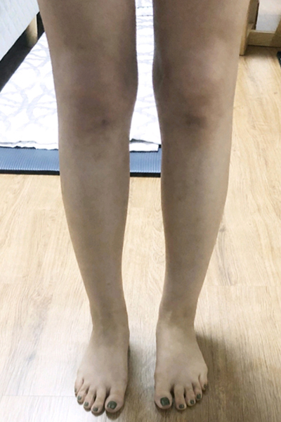 [Өөх соруулах] Күүлтабин - Гуя, хэвлийн өөх соруулах