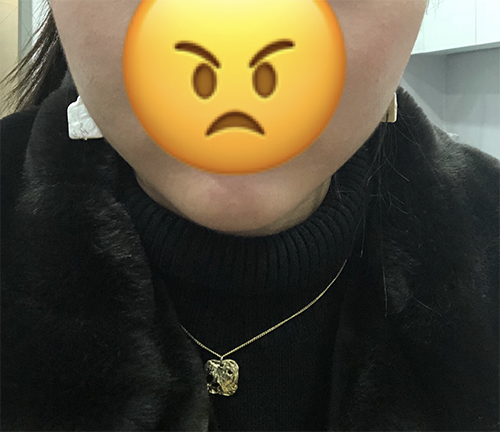 [Жижиг] Минжани - Ботокс, эрүүний үзүүрийн филлер